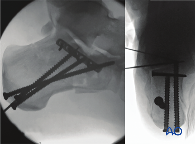 Minimally Invasive K‑Wire and Screw Fixation for Calcaneal Fractures