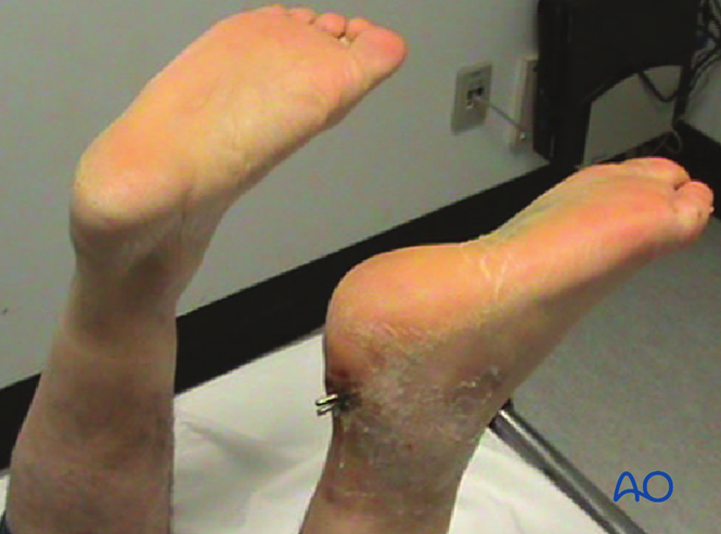 Minimally Invasive K‑Wire and Screw Fixation for Calcaneal Fractures