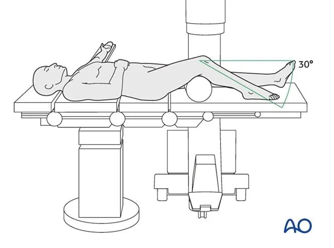 Retrograde Intramedullary Nailing for Periprosthetic Femoral Fractures After TKA: AO Standardized Surgical Strategy – Illustrated Step-by-Step Guide