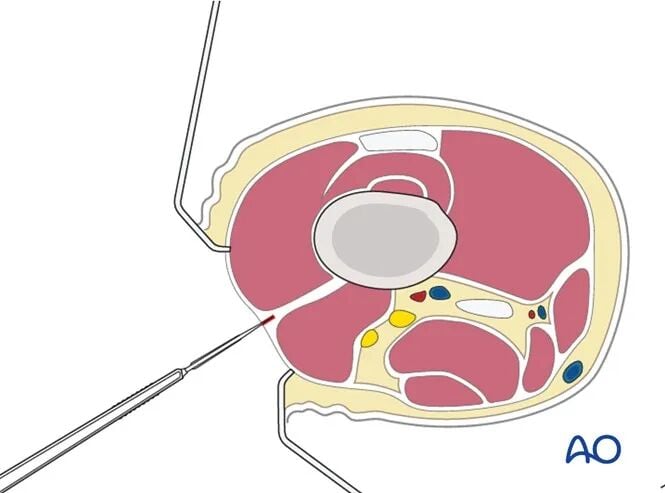 Minimally Invasive Lateral/Anterolateral MIPO Approach to the Distal Femur
