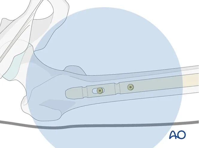 Retrograde Intramedullary Nailing for Periprosthetic Femoral Fractures After TKA: AO Standardized Surgical Strategy – Illustrated Step-by-Step Guide