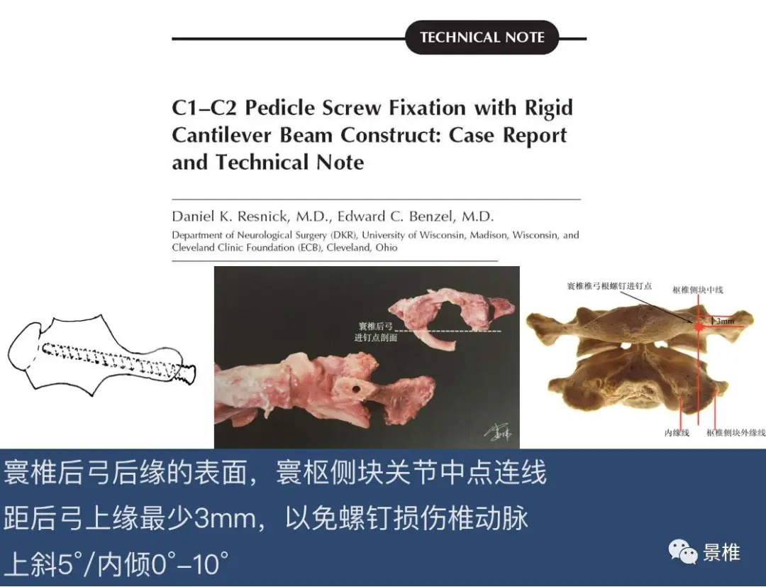 Pedicle Screw Placement Techniques for the Cervical, Thoracic, and Lumbar Spine