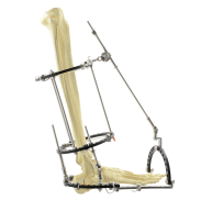 Understanding Ilizarov External Fixation Bracket: Principles and Applications