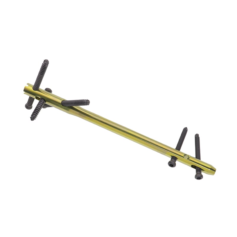 Extendable intramedullary nail: adjustable length to meet individualized clinical needs