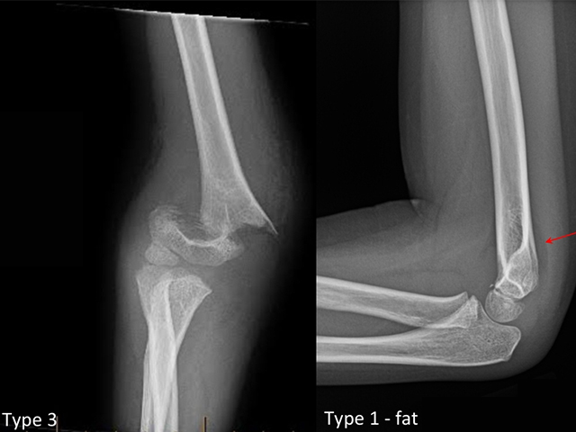 Treatment of Pediatric Supracondylar Humerus Fractures