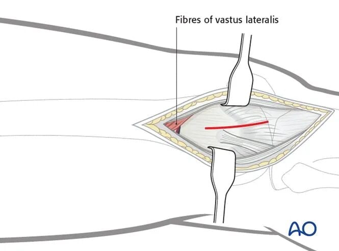 Minimally Invasive Lateral/Anterolateral MIPO Approach to the Distal Femur