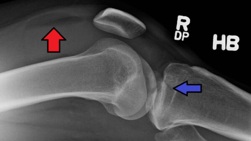 X-ray interpretation (ABCS approach)