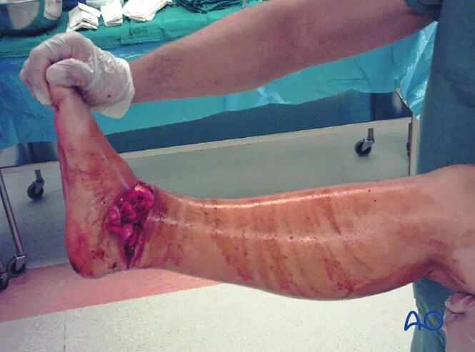 AO Standard Surgery: Screw Fixation for Displaced Talar Neck Fractures