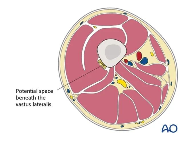 Minimally Invasive Lateral/Anterolateral MIPO Approach to the Distal Femur