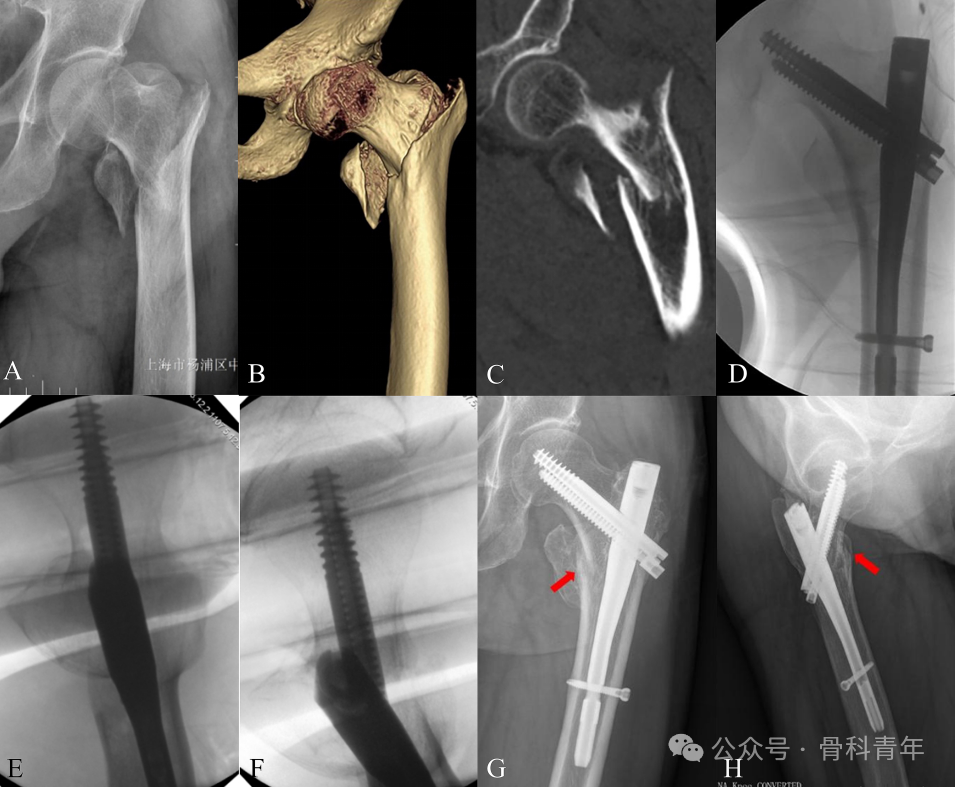 Characteristics and Surgical Techniques of the "Double‑Intra" Type of Irreducible Intertrochanteric Fractures