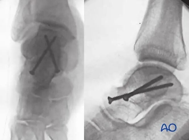 AO Standard Surgery: Screw Fixation for Displaced Talar Neck Fractures