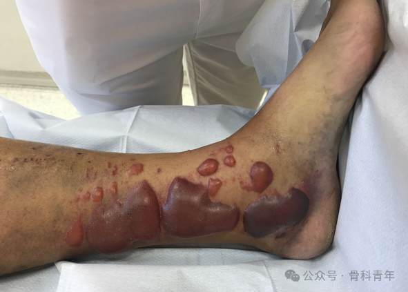 Surgical Steps