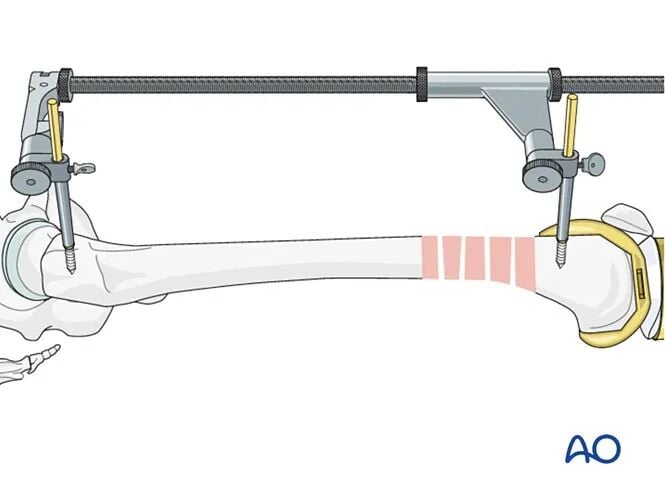 Retrograde Intramedullary Nailing for Periprosthetic Femoral Fractures After TKA: AO Standardized Surgical Strategy – Illustrated Step-by-Step Guide