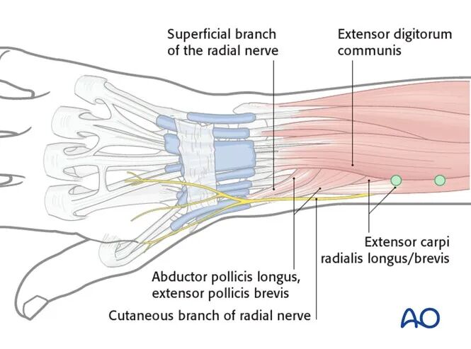 Transarticular External Fixation for Distal Radius Fractures