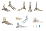 Biomechanical Advantages of Ankle Locking Plate Technology