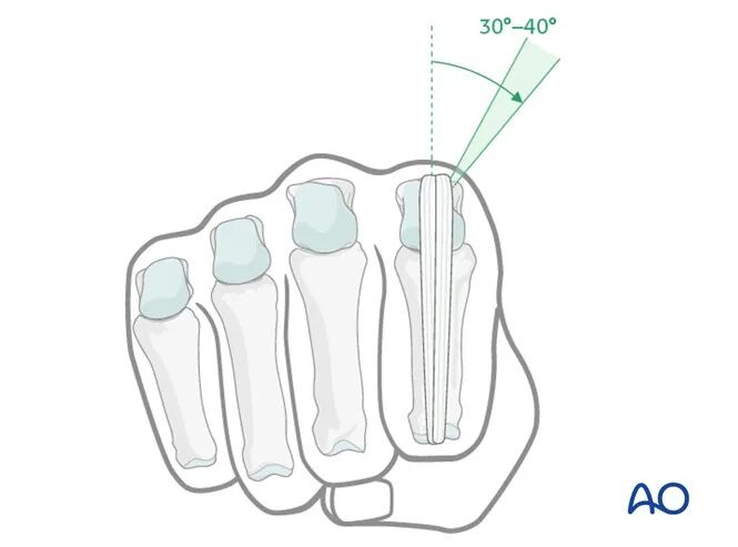 Transarticular External Fixation for Distal Radius Fractures