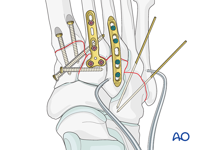 IV. Approach Preparation