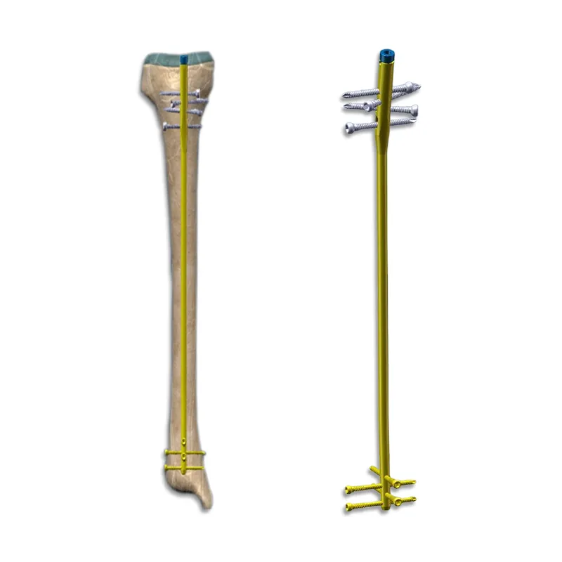Pediatric internal fixation system: Innovative application of extendable intramedullary nail in orthopedic treatment