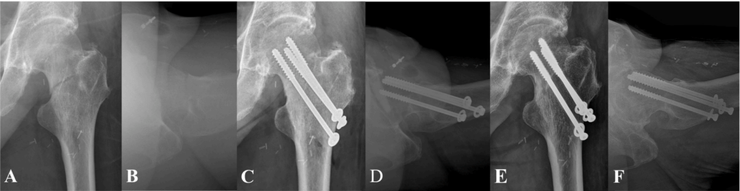 Femoral Neck Fracture Fixation Techniques: Latest Research Advances—A Narrative Review