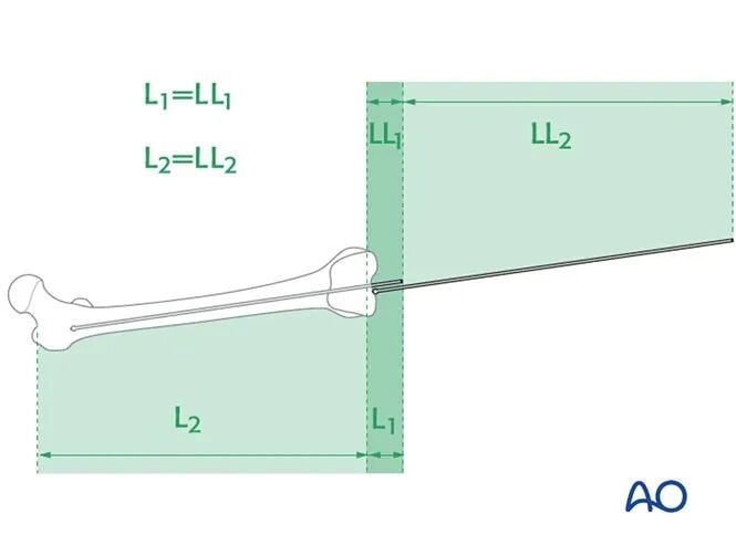 Retrograde Intramedullary Nailing for Periprosthetic Femoral Fractures After TKA: AO Standardized Surgical Strategy – Illustrated Step-by-Step Guide