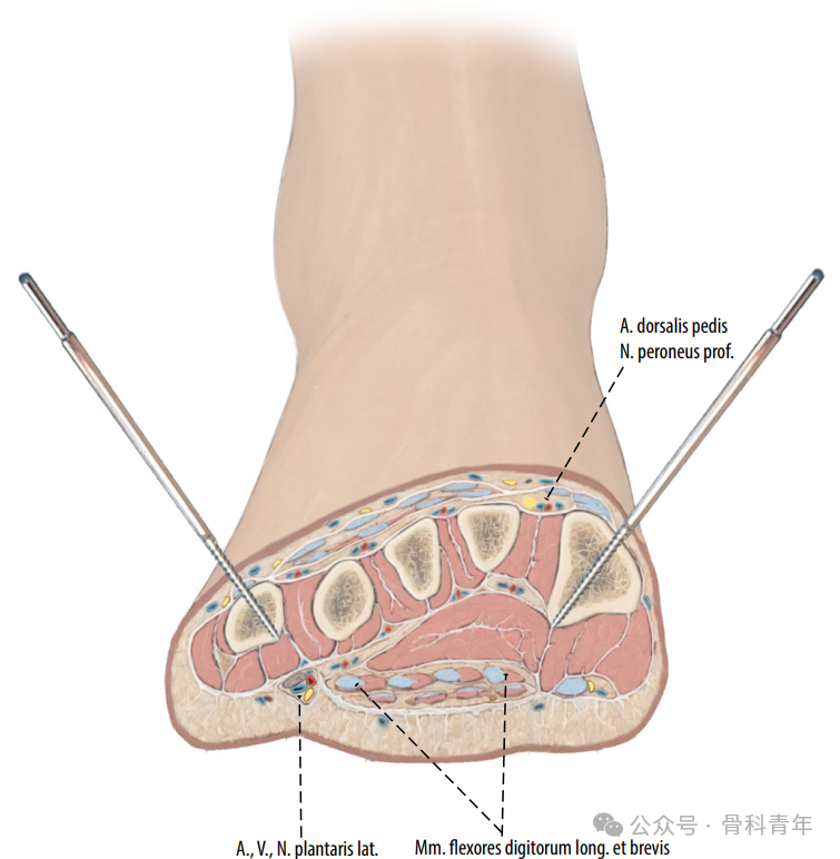 Surgical Steps