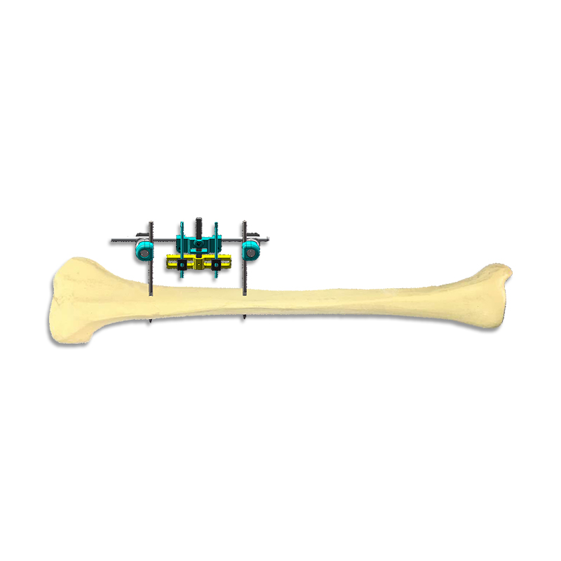 Horizontal Bone Transporter Combined System