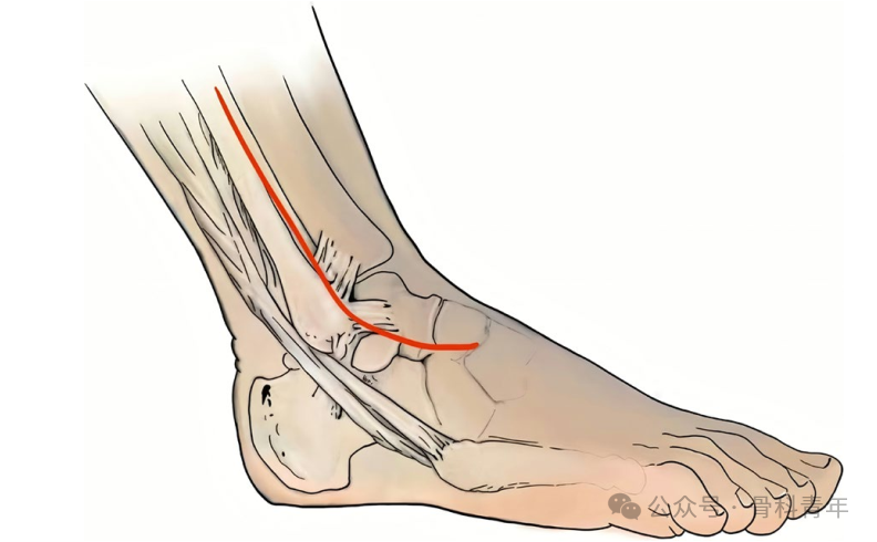 Complex Pilon Fractures: The "Four Principles" and the "Four-Step Foundation Method"