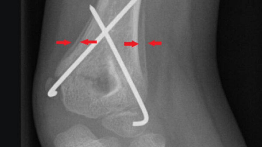 X-ray interpretation (ABCS approach)