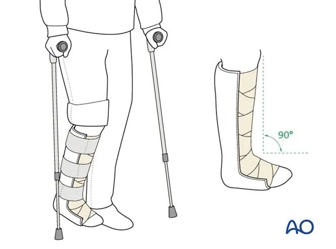 AO Standard Surgery: Screw Fixation for Displaced Talar Neck Fractures