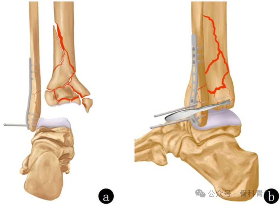 Complex Pilon Fractures: The "Four Principles" and the "Four-Step Foundation Method"