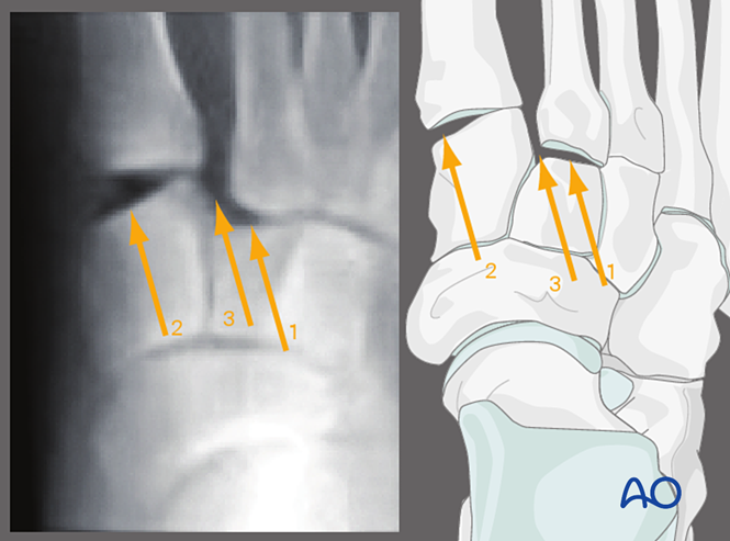 IV. Approach Preparation