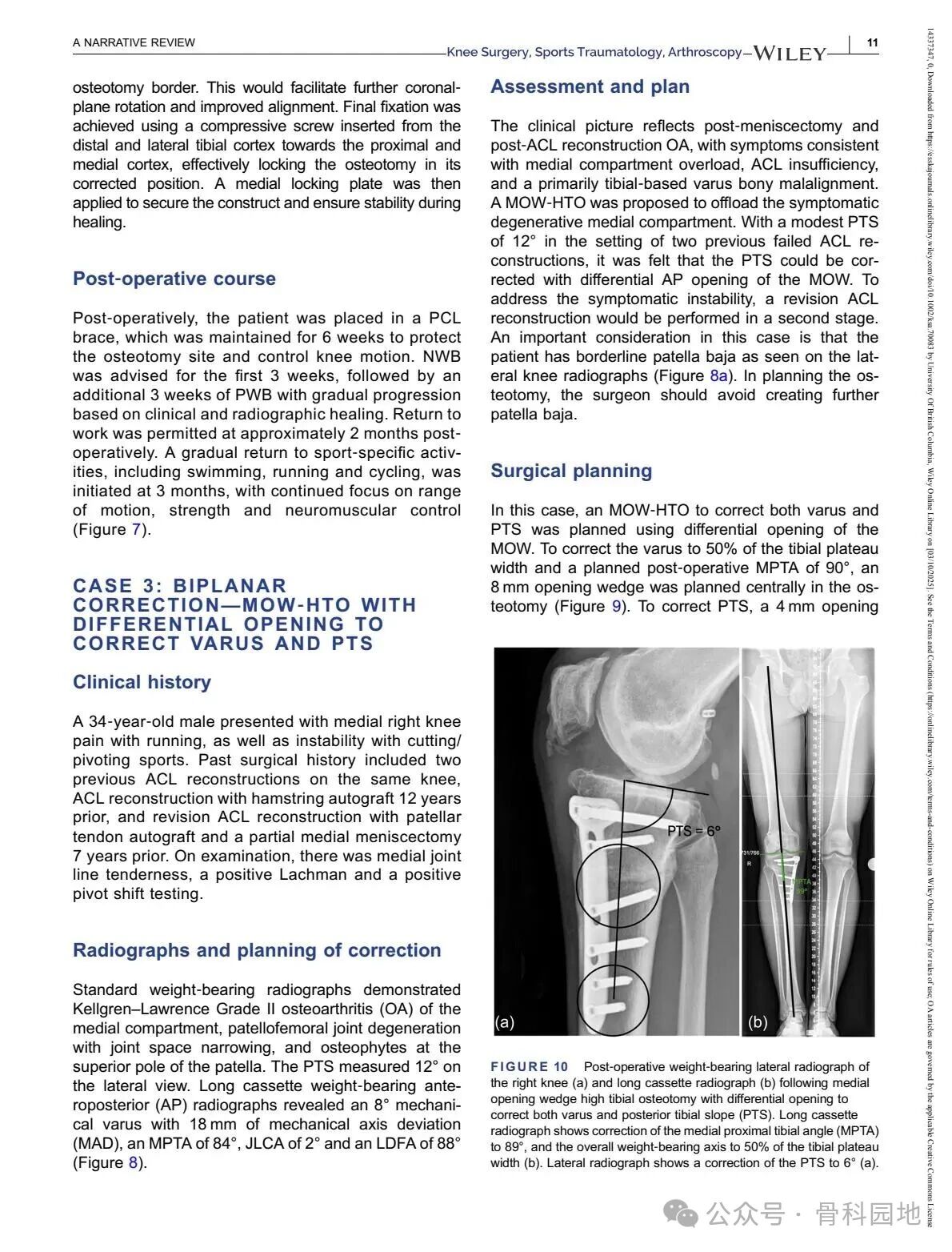 Technical Tips and Tricks for Complex Biplanar High Tibial Osteotomy