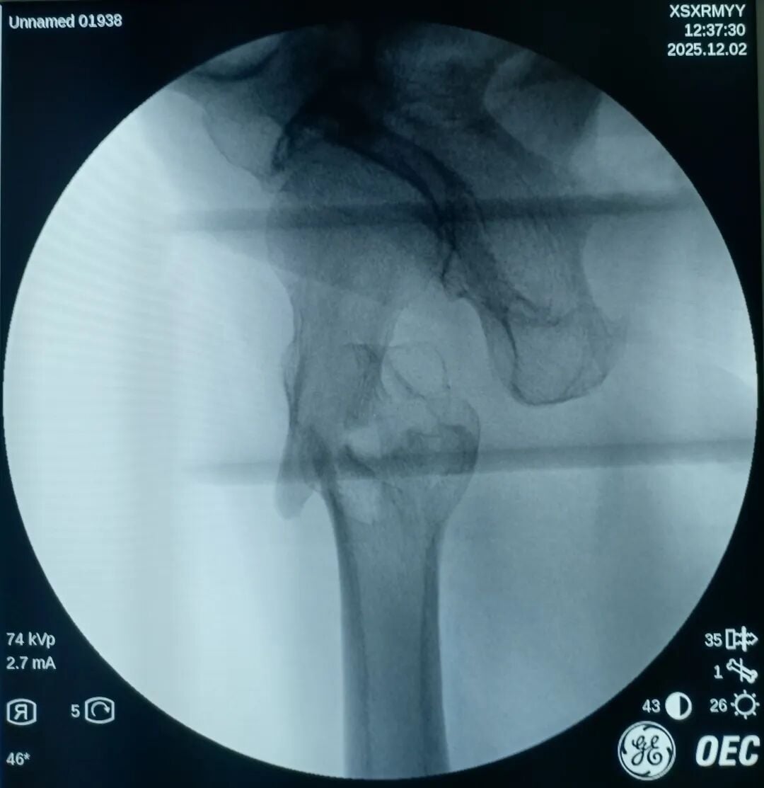 The "Gold Standard Procedure" in Orthopedics: Intramedullary Nailing for Intertrochanteric Fractures – Precise Reduction + Fast Recovery