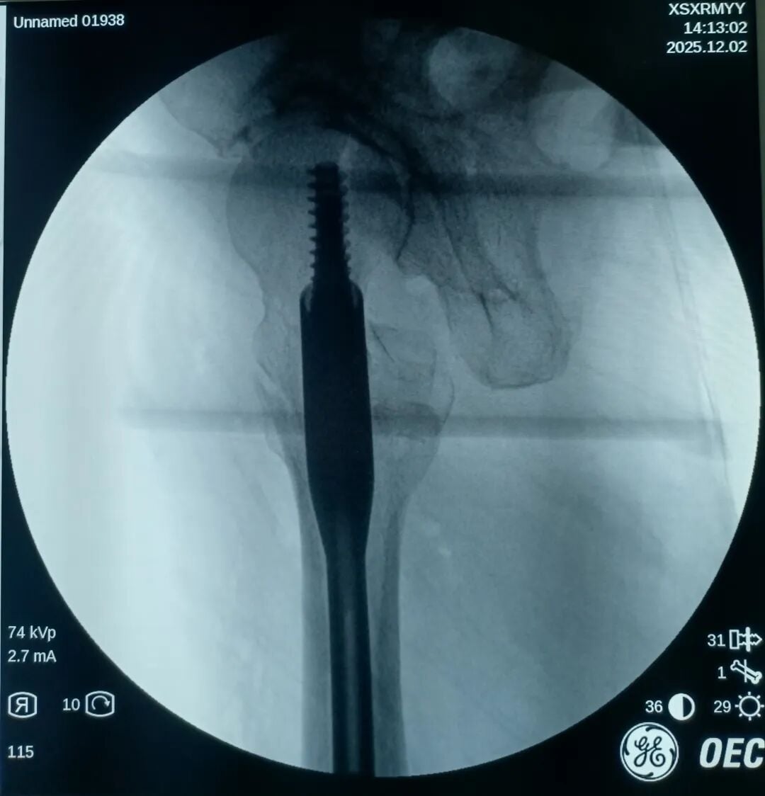 The "Gold Standard Procedure" in Orthopedics: Intramedullary Nailing for Intertrochanteric Fractures – Precise Reduction + Fast Recovery