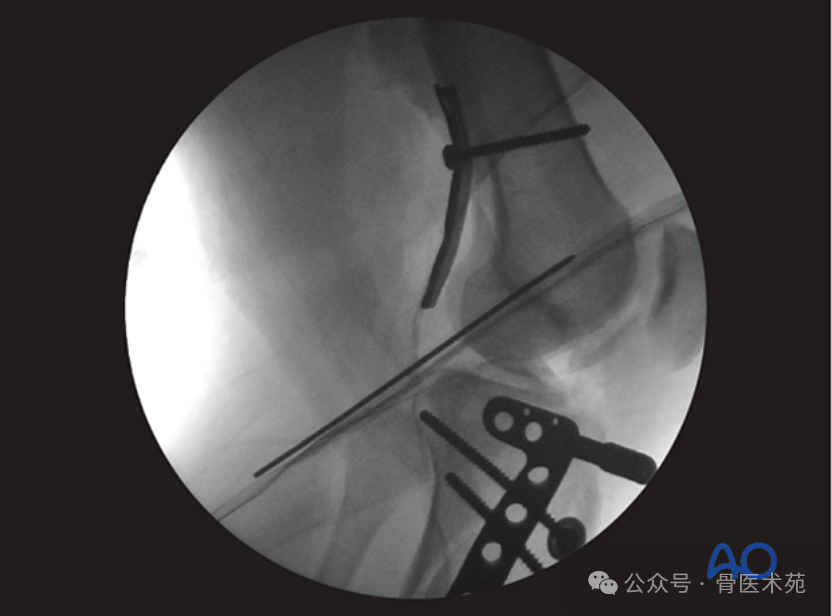 Open Reduction and Internal Fixation of Hoffa Fracture with Plate and Screws
