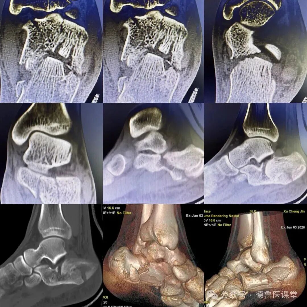 How to Perform a Successful Minimally Invasive Calcaneal Surgery