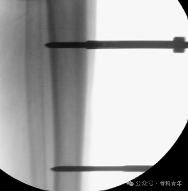 Surgical Steps