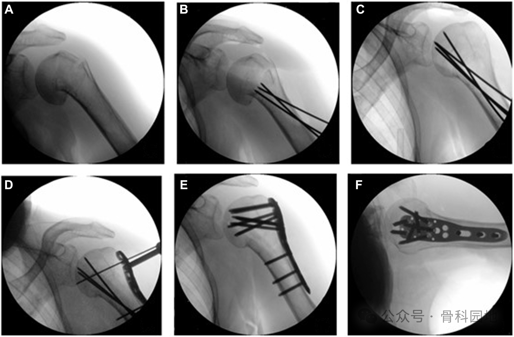Standardized Reduction Technique in Proximal Humerus Fractures