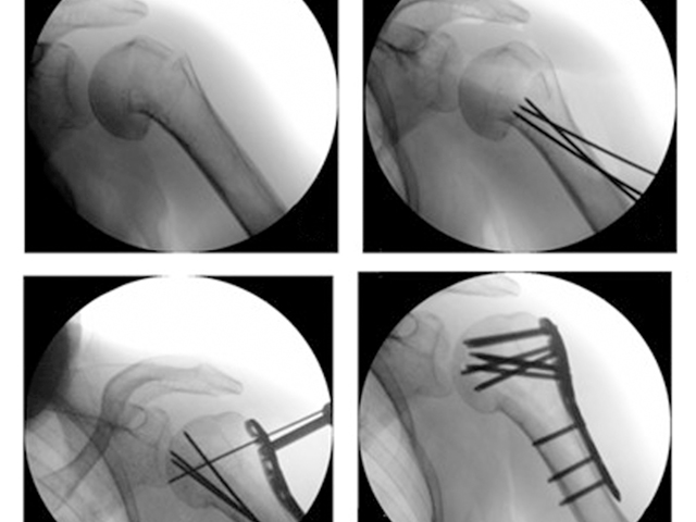 Standardized Reduction Technique in Proximal Humerus Fractures