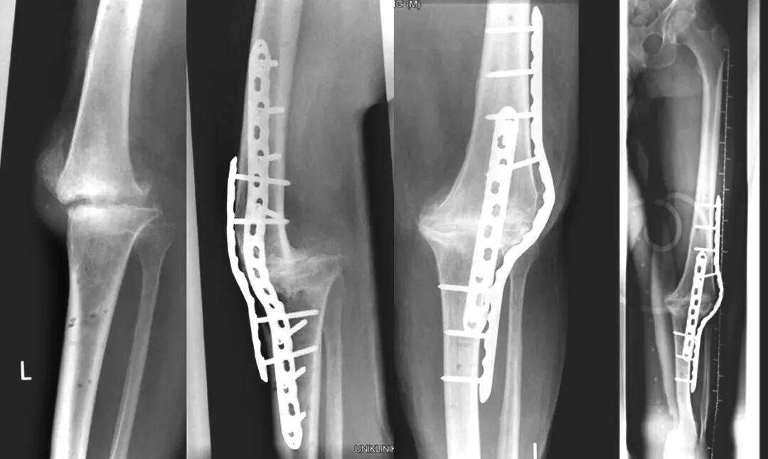 Locking Compression Plate (LCP): Principles and Clinical Applications