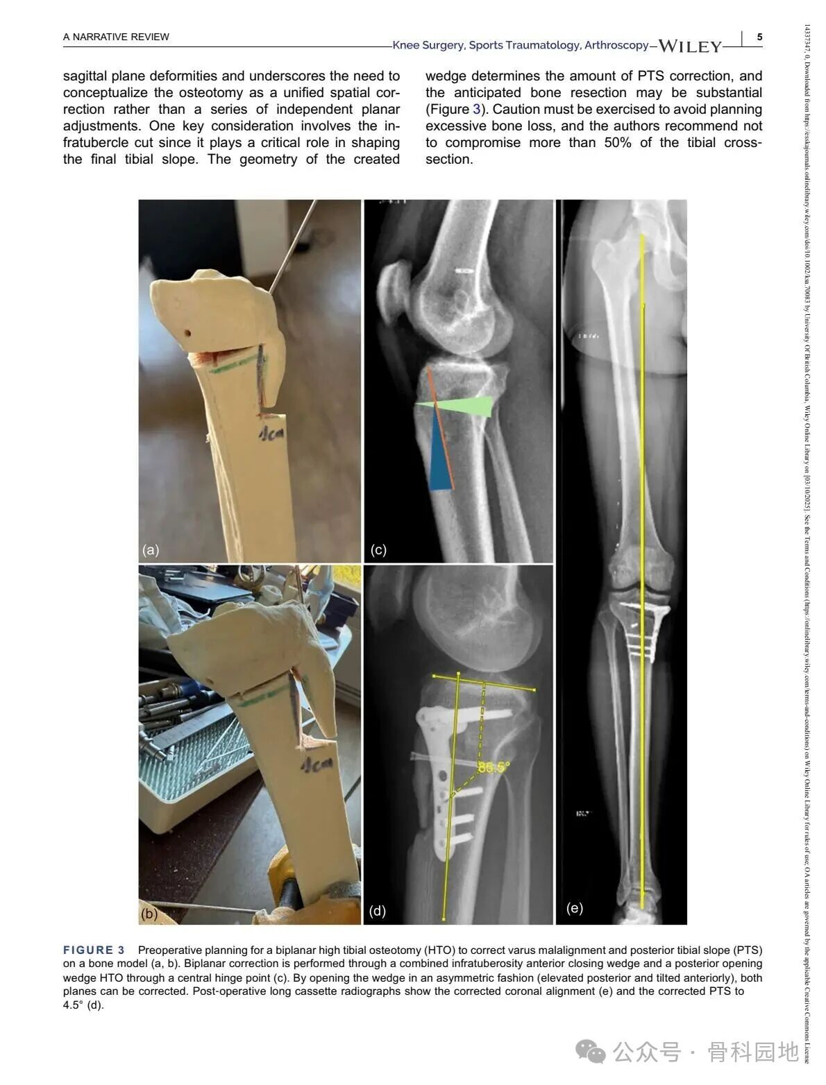 Technical Tips and Tricks for Complex Biplanar High Tibial Osteotomy
