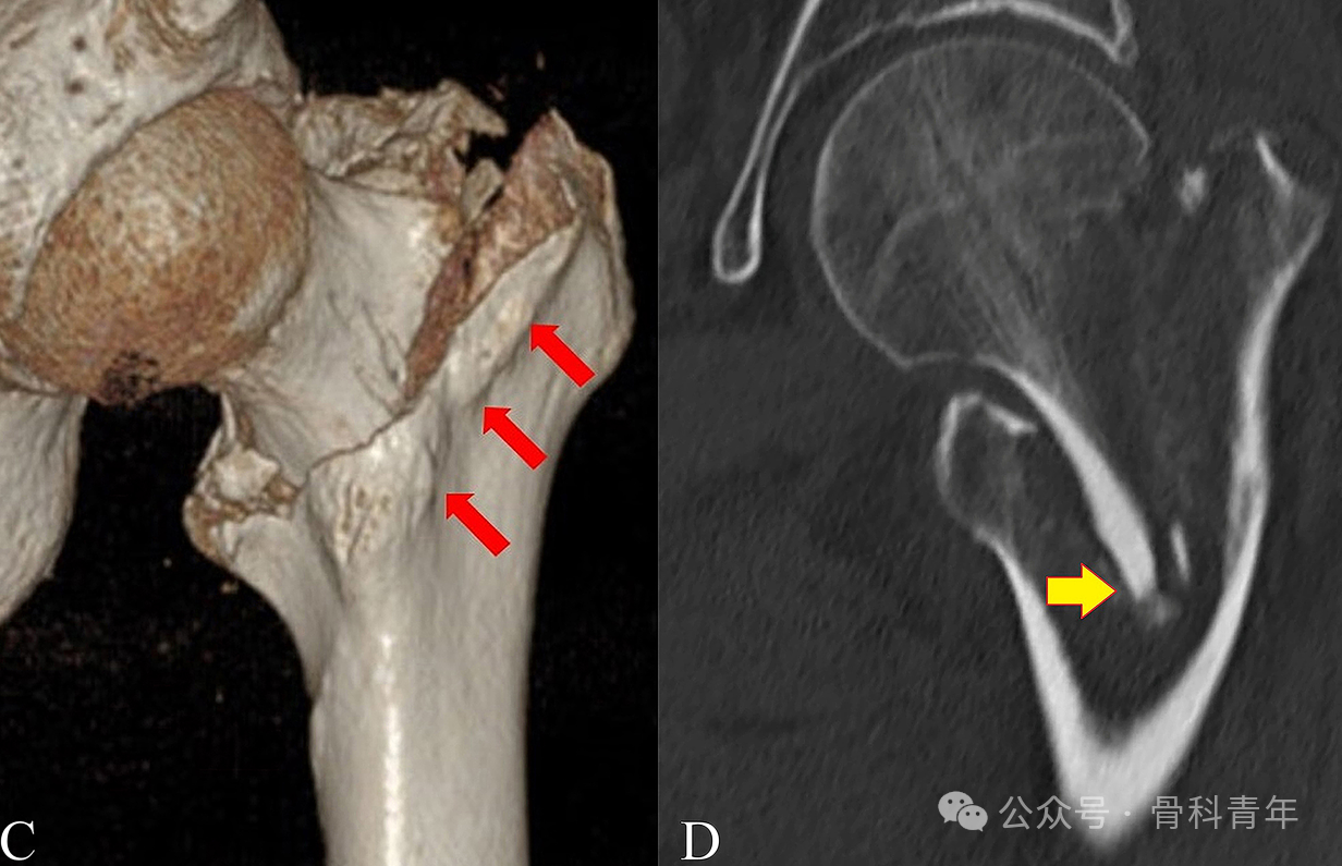 Characteristics and Surgical Techniques of the "Double‑Intra" Type of Irreducible Intertrochanteric Fractures