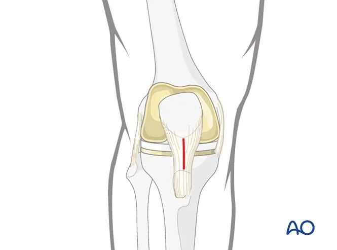 Retrograde Intramedullary Nailing for Periprosthetic Femoral Fractures After TKA: AO Standardized Surgical Strategy – Illustrated Step-by-Step Guide