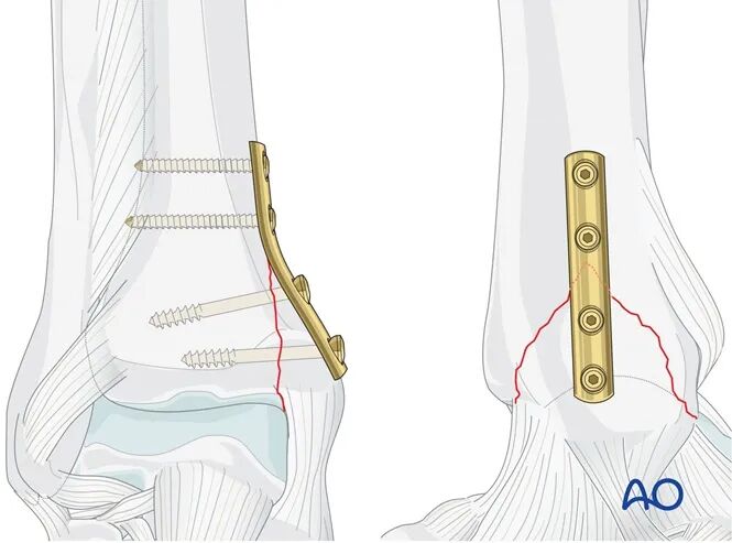 AO Standard Technique: Buttress Plate Fixation for Medial Malleolus Fractures