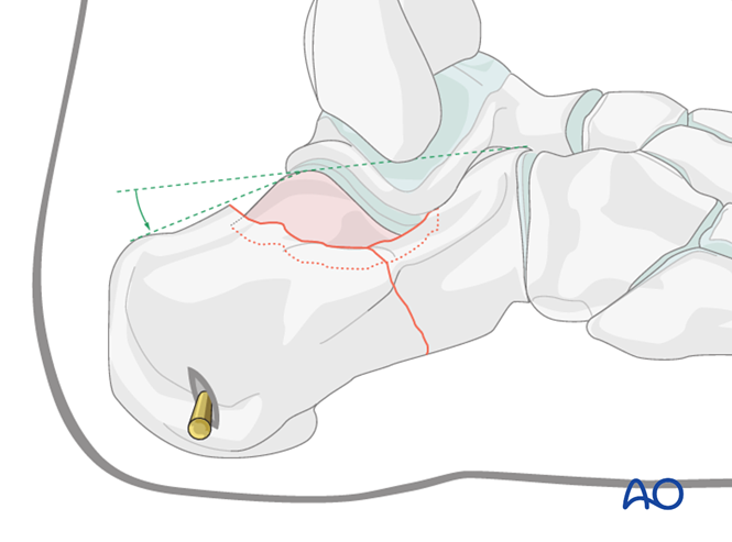 Minimally Invasive K‑Wire and Screw Fixation for Calcaneal Fractures