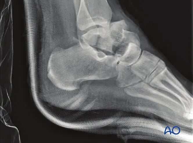 AO Standard Surgery: Screw Fixation for Displaced Talar Neck Fractures