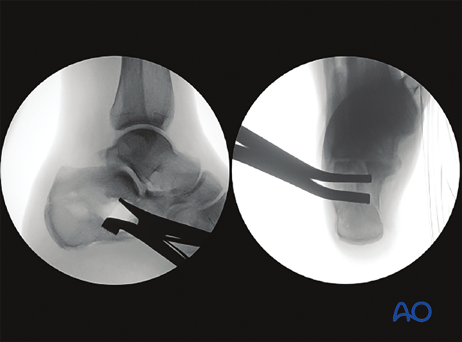 Minimally Invasive K‑Wire and Screw Fixation for Calcaneal Fractures