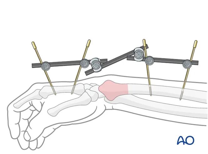 Transarticular External Fixation for Distal Radius Fractures