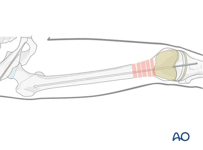 Retrograde Intramedullary Nailing for Periprosthetic Femoral Fractures After TKA: AO Standardized Surgical Strategy – Illustrated Step-by-Step Guide