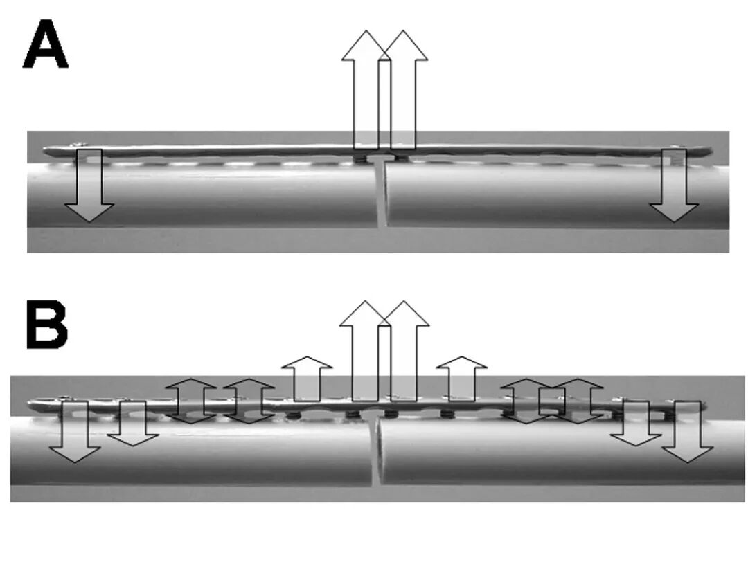 Locking Compression Plate (LCP): Principles and Clinical Applications